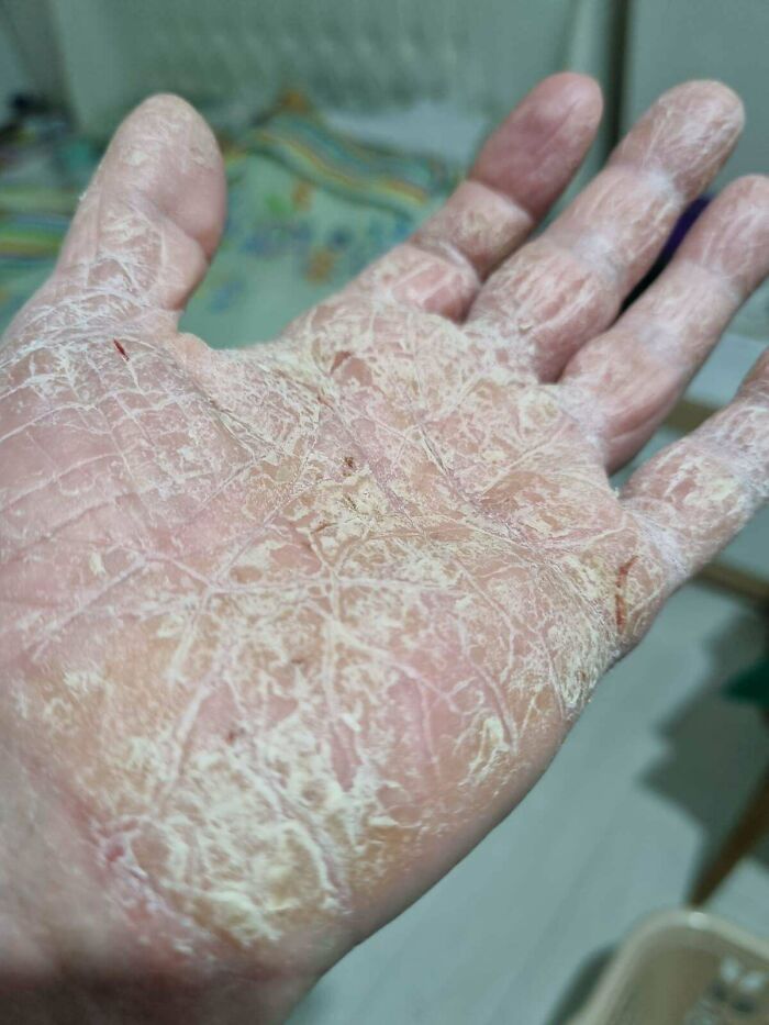 My Mum’s Hands: A Tale of Hyperkeratotic Palmar Dermatitis