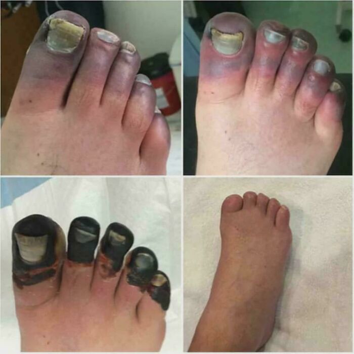 Extreme Frostbite: Climber's Battle on Mt. Everest