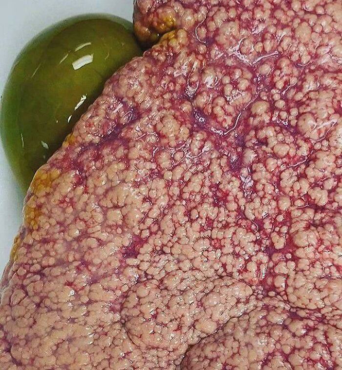 Liver Cirrhosis in Classic Medical Close-Up