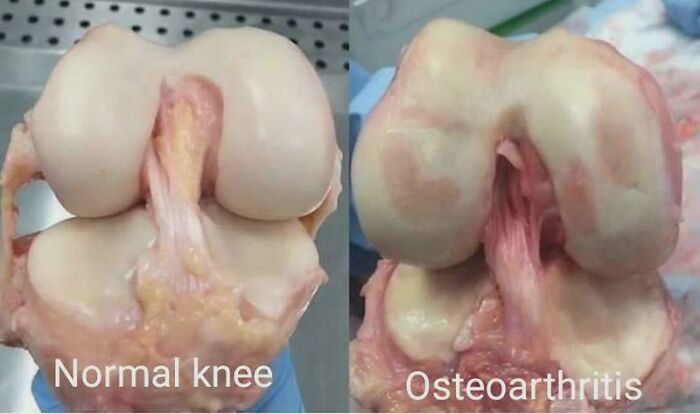 Osteoarthritis Looked at Close Up