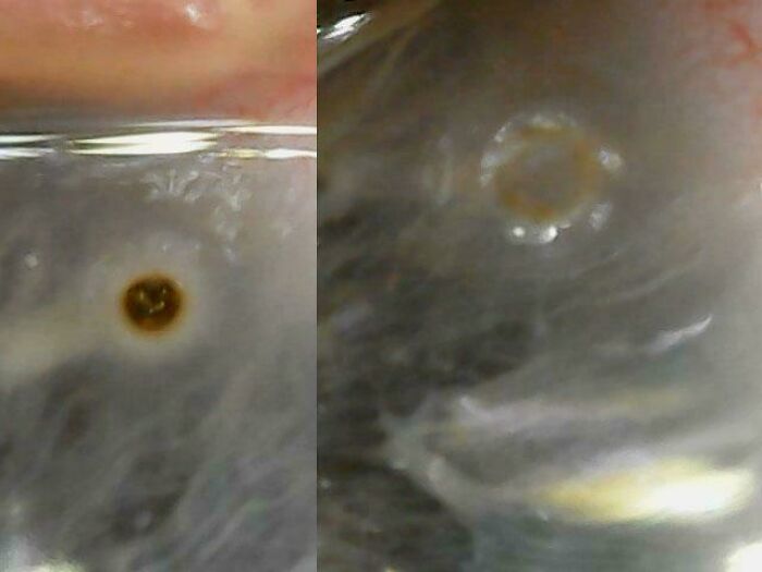 Ouch! Metal Chunk Stuck in Eyeball Even with a Face Shield