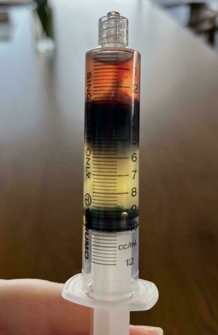 Blood Separates Like a Science Experiment (Around 24 Hours Later)