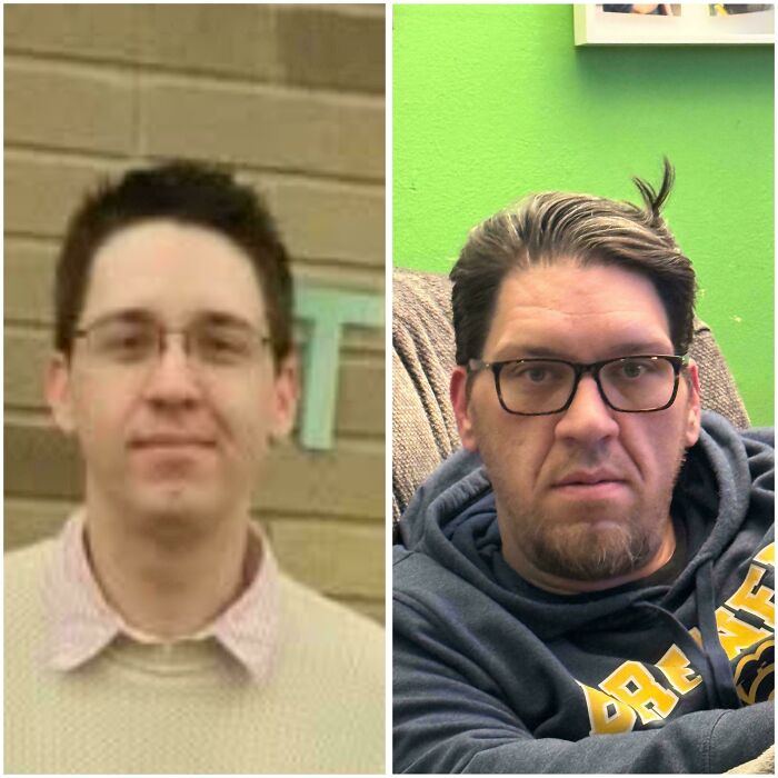 My Husband’s Face Changed from 2011 to 2025 Thanks to Acromegaly