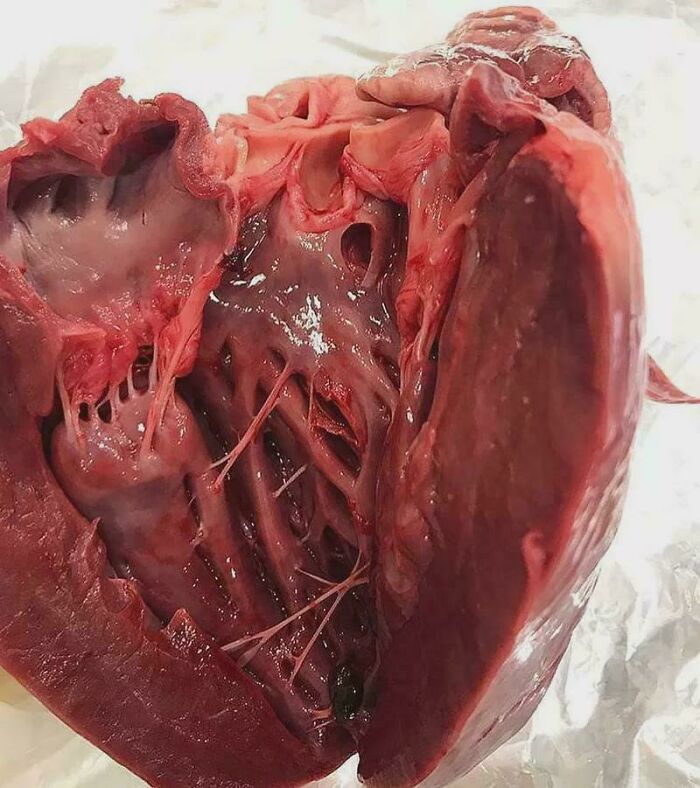 Hypertrophic Cardiomyopathy: Thickening Heart Gets Its Own Close-Up