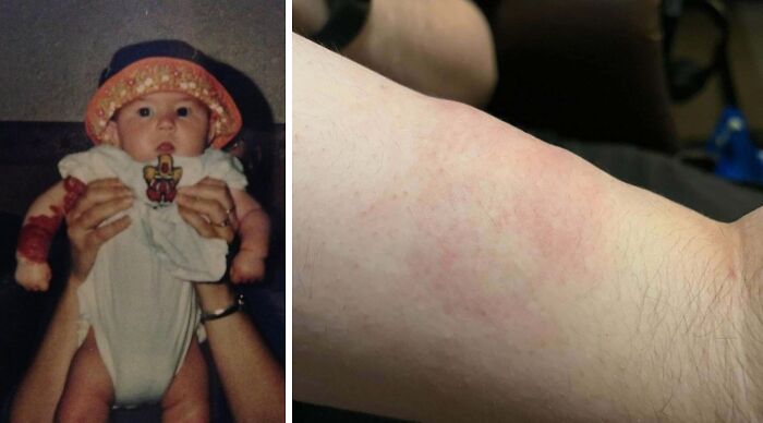 Strawberry Nevus Hemangioma and a Terrible Blood Clot Story