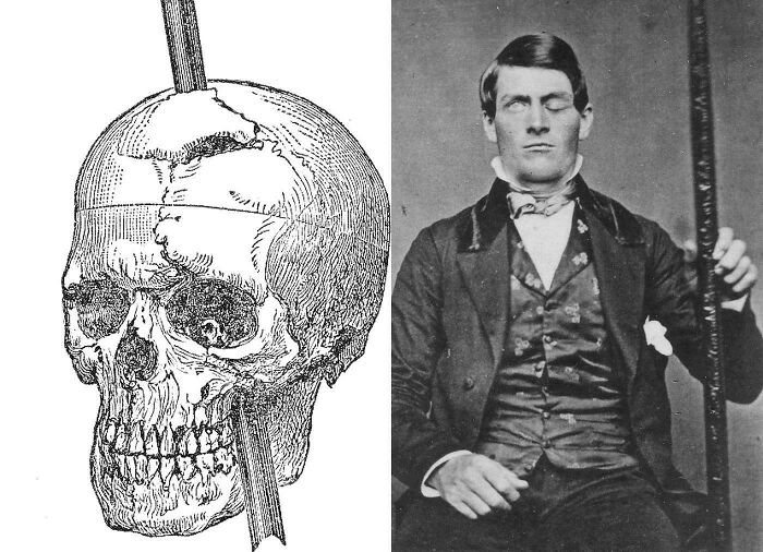 Phineas Gage Survived A Rod Through His Skull And Lived To Tell The Tale