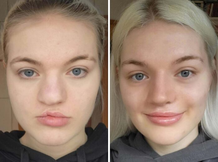 Rhinoplasty Adventure: Tackling My Cleft Lip & Palate