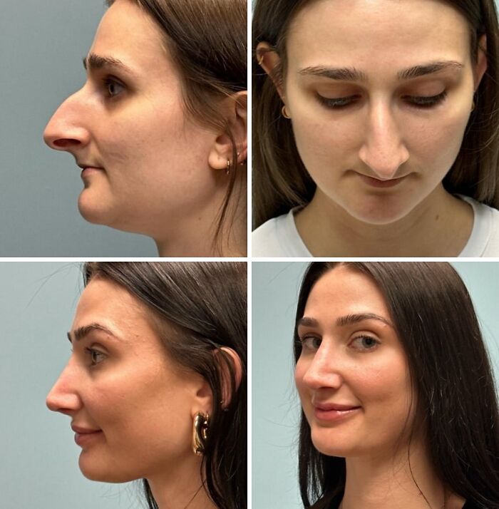 Nose Job & Lip Filler: The Mixed Bag