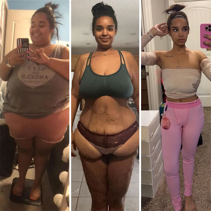 From 357lbs to 115lbs: Loose Skin Be Gone!