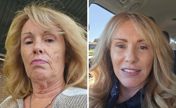 12 Days Post Op: Face and Neck Lift Glow-Up