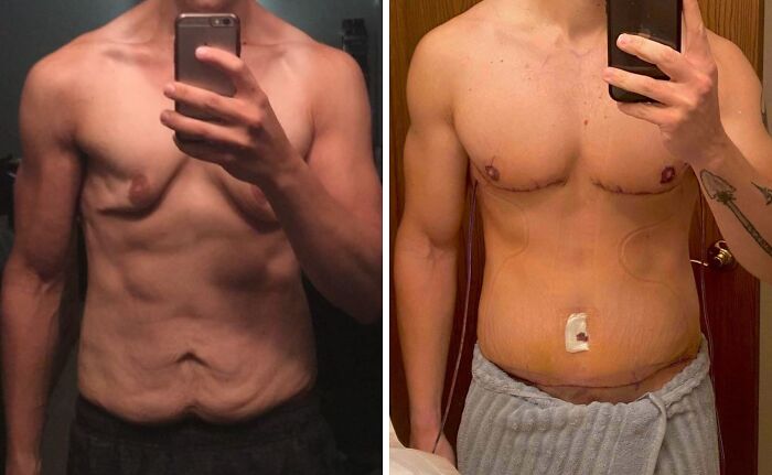 315lbs To 180lbs and Finally Cut The Loose Skin!