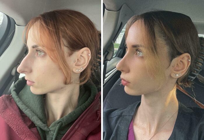 Nose Job Glow-Up: Couldn’t Be Happier A Month Later!