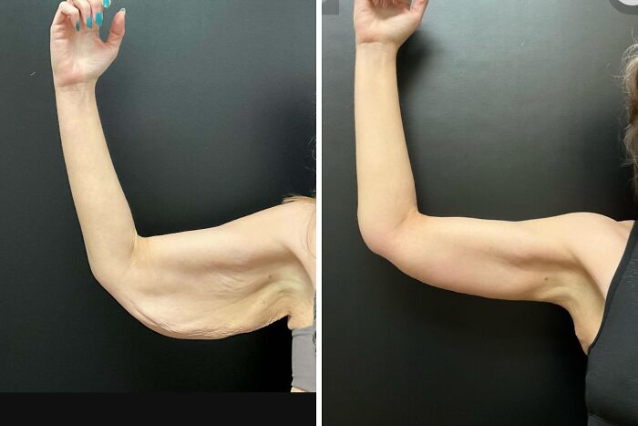 Arm Lift After Dropping 150lbs: Yes To Confidence!