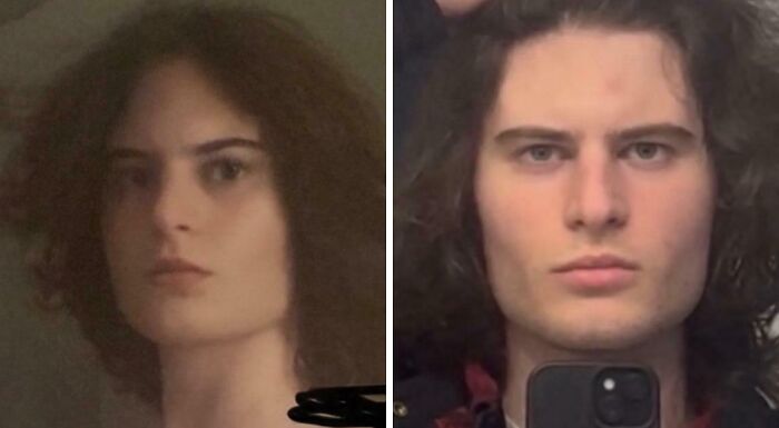 FTM Facial Masculinization: One Year Later Vibes