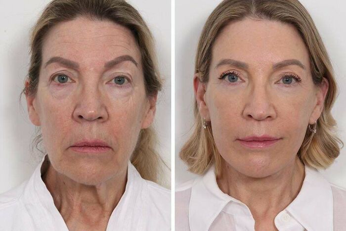 41 Plastic Surgery Glow-Ups That Will Make You Look Twice