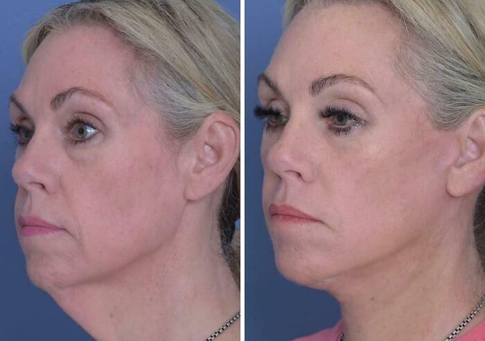 41 Plastic Surgery Glow-Ups That Will Make You Look Twice