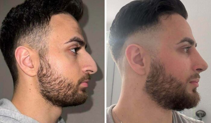 41 Plastic Surgery Glow-Ups That Will Make You Look Twice