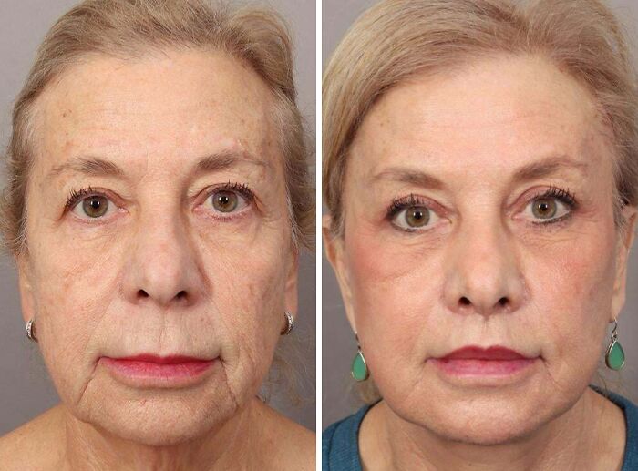 41 Plastic Surgery Glow-Ups That Will Make You Look Twice