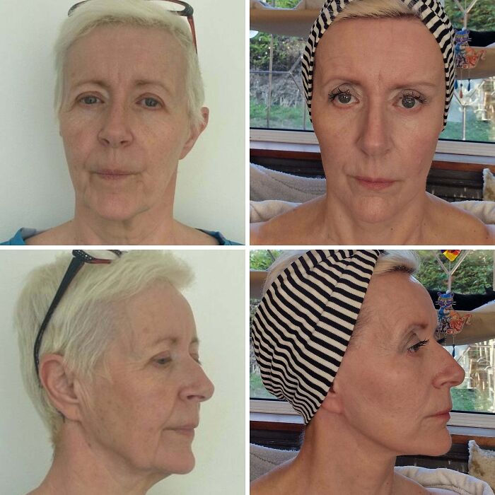 41 Plastic Surgery Glow-Ups That Will Make You Look Twice