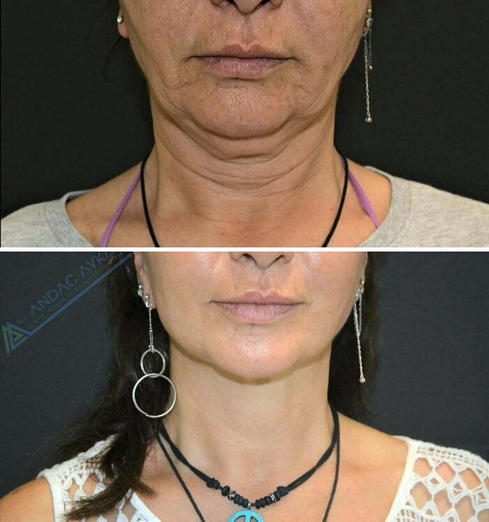 41 Plastic Surgery Glow-Ups That Will Make You Look Twice