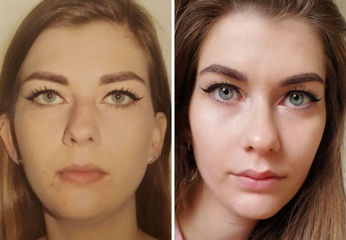 41 Plastic Surgery Glow-Ups That Will Make You Look Twice
