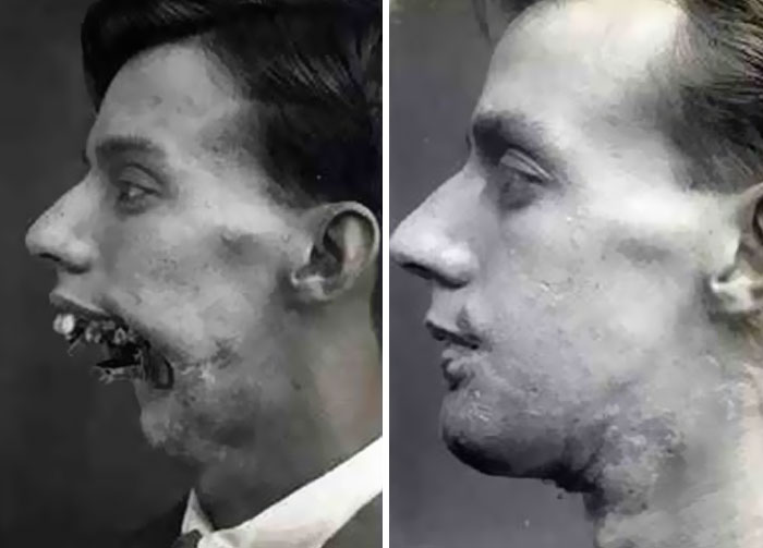 1916 Facial Surgery Lookin’ Like Magic!