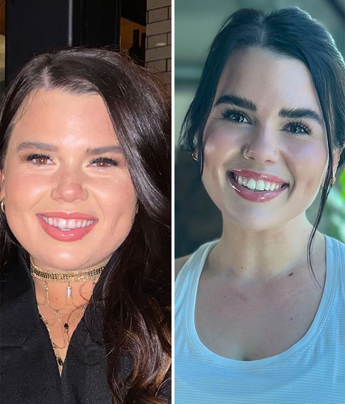 Wait, They Actually Shared Their Ozempic Face Transformations?!