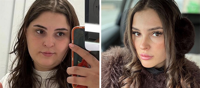 Wait, They Actually Shared Their Ozempic Face Transformations?!