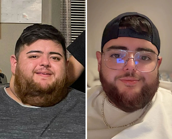 Wait, They Actually Shared Their Ozempic Face Transformations?!