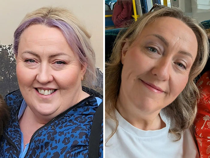 Wait, They Actually Shared Their Ozempic Face Transformations?!