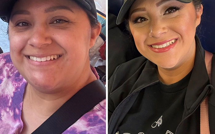 Wait, They Actually Shared Their Ozempic Face Transformations?!