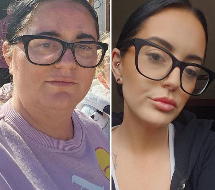 Wait, They Actually Shared Their Ozempic Face Transformations?!