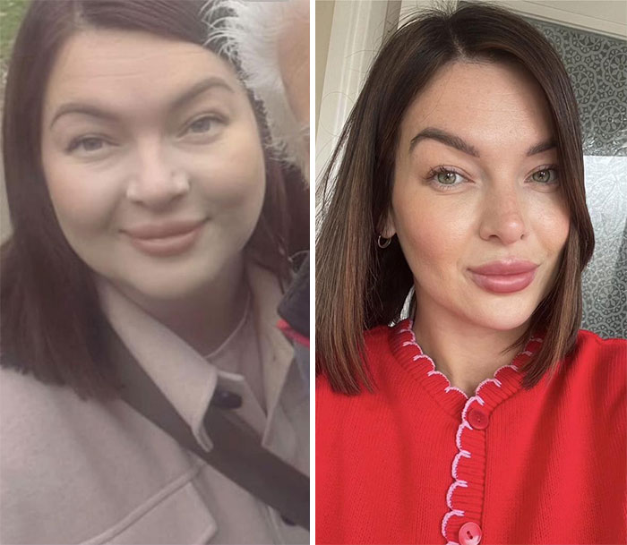 Wait, They Actually Shared Their Ozempic Face Transformations?!