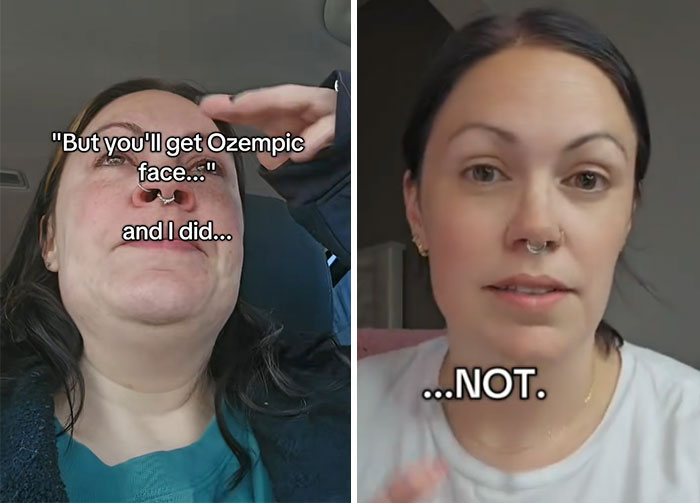 Wait, They Actually Shared Their Ozempic Face Transformations?!