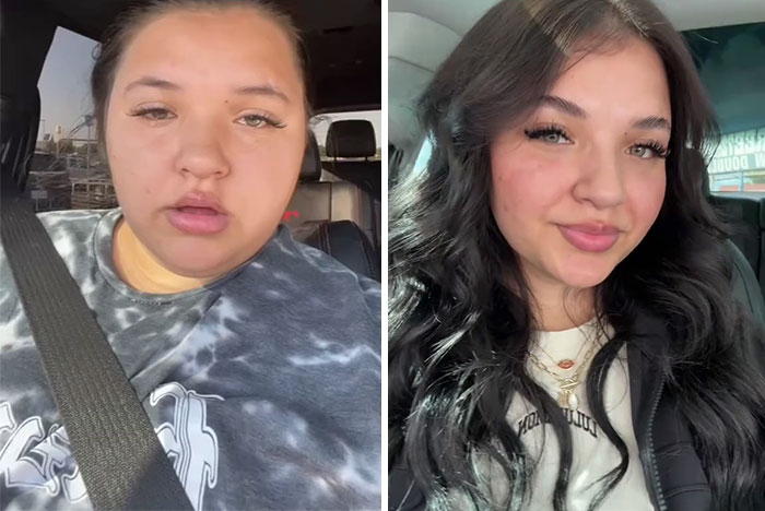 Wait, They Actually Shared Their Ozempic Face Transformations?!