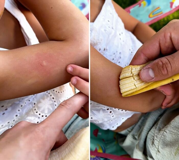 Banana Peels: Your Itchy Mosquito Bite’s Worst Enemy