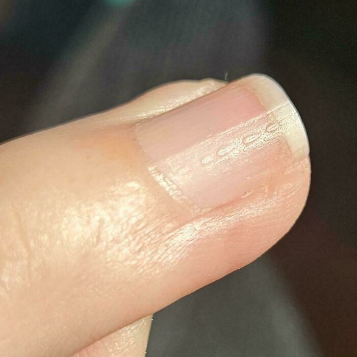 Some of My Nails Decided to Get Bumpy