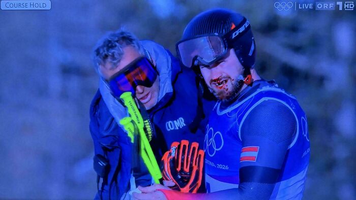 Daniel Hemetsberger Lost Teeth In A Training Crash (Ouch!)