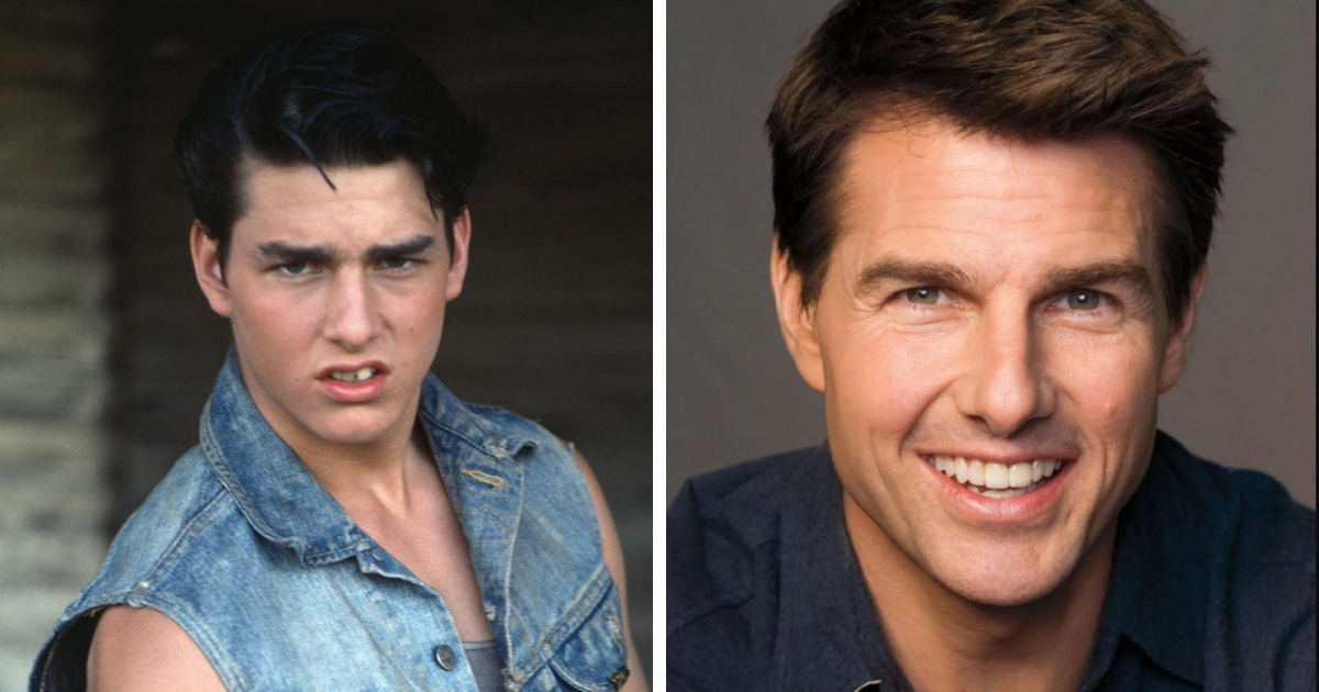 Smile Swaps: 12 Celebs Who Went From Gaps to Glam