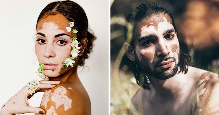 Wait, They Actually Made Vitiligo Look This Cool? 35 Pics That’ll Blow Your Mind