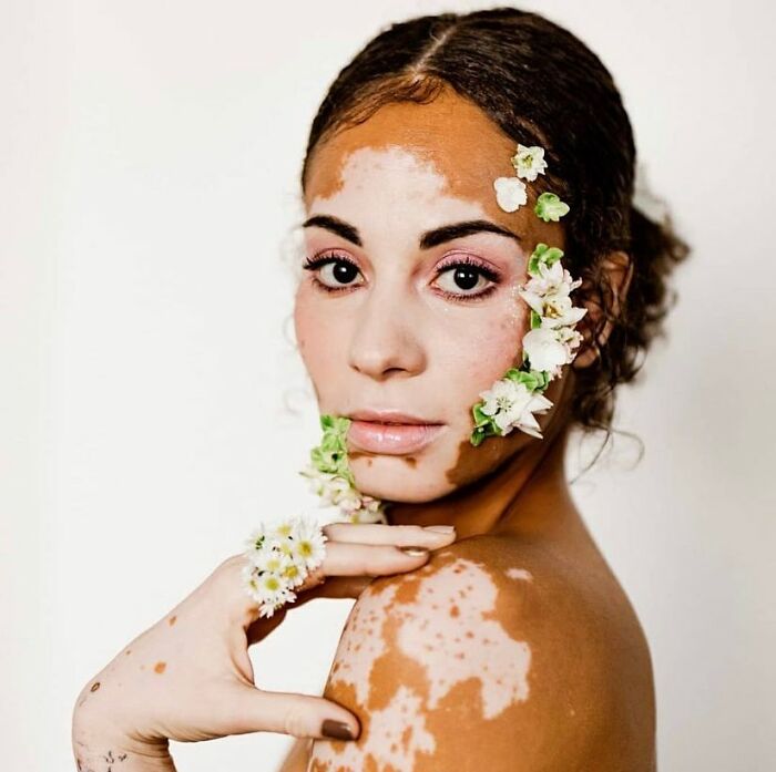 Wait, They Actually Made Vitiligo Look This Cool? 35 Pics That’ll Blow Your Mind