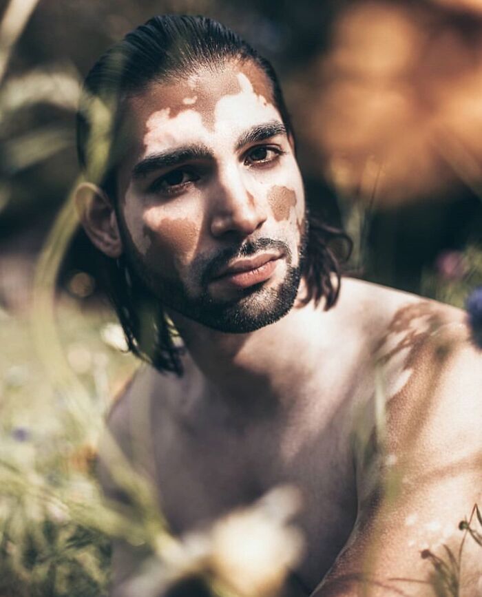 Wait, They Actually Made Vitiligo Look This Cool? 35 Pics That’ll Blow Your Mind