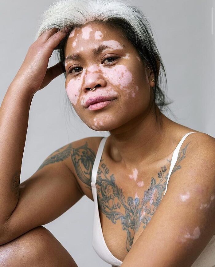 Wait, They Actually Made Vitiligo Look This Cool? 35 Pics That’ll Blow Your Mind