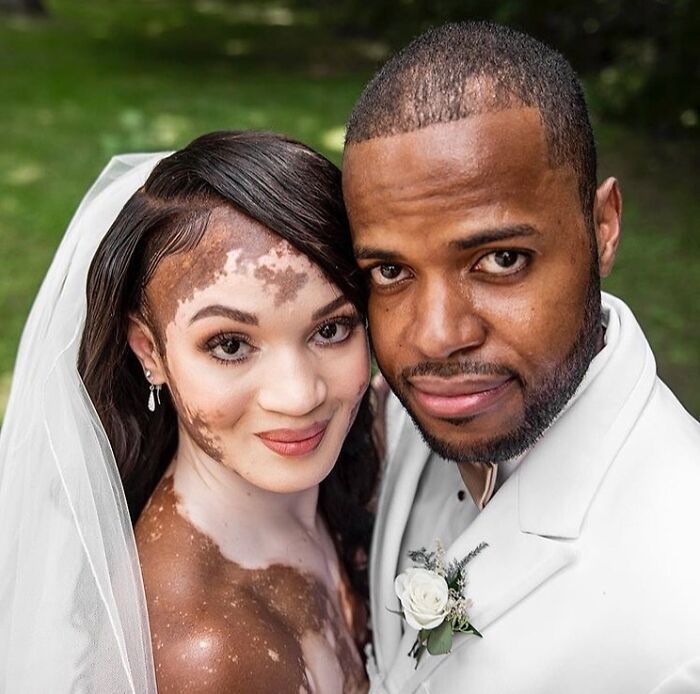 Wait, They Actually Made Vitiligo Look This Cool? 35 Pics That’ll Blow Your Mind