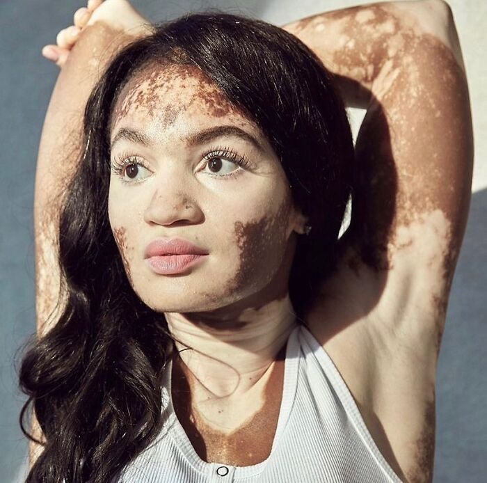 Wait, They Actually Made Vitiligo Look This Cool? 35 Pics That’ll Blow Your Mind