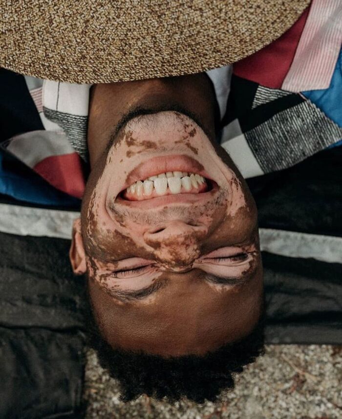 Wait, They Actually Made Vitiligo Look This Cool? 35 Pics That’ll Blow Your Mind