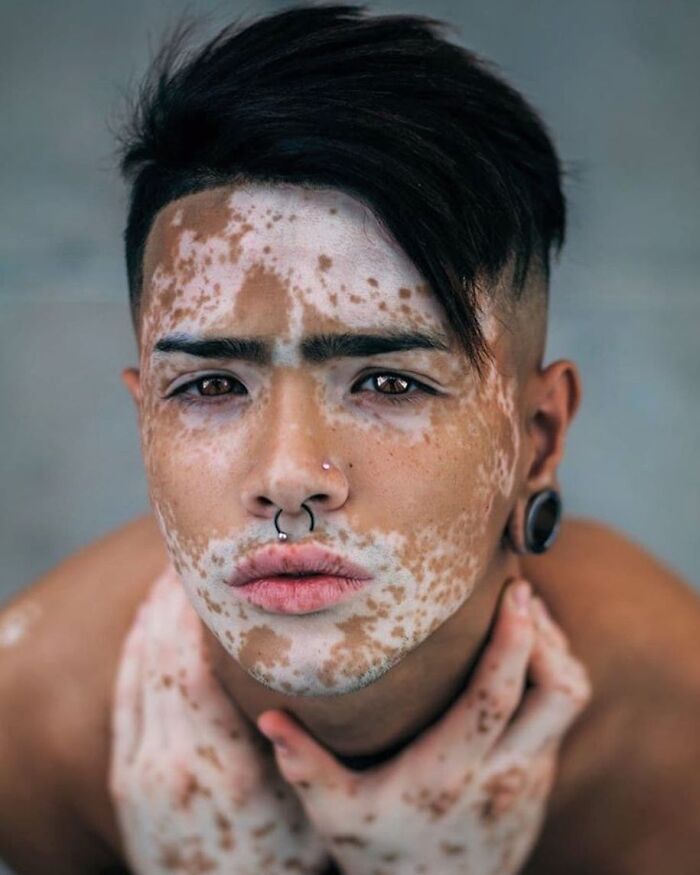 Wait, They Actually Made Vitiligo Look This Cool? 35 Pics That’ll Blow Your Mind