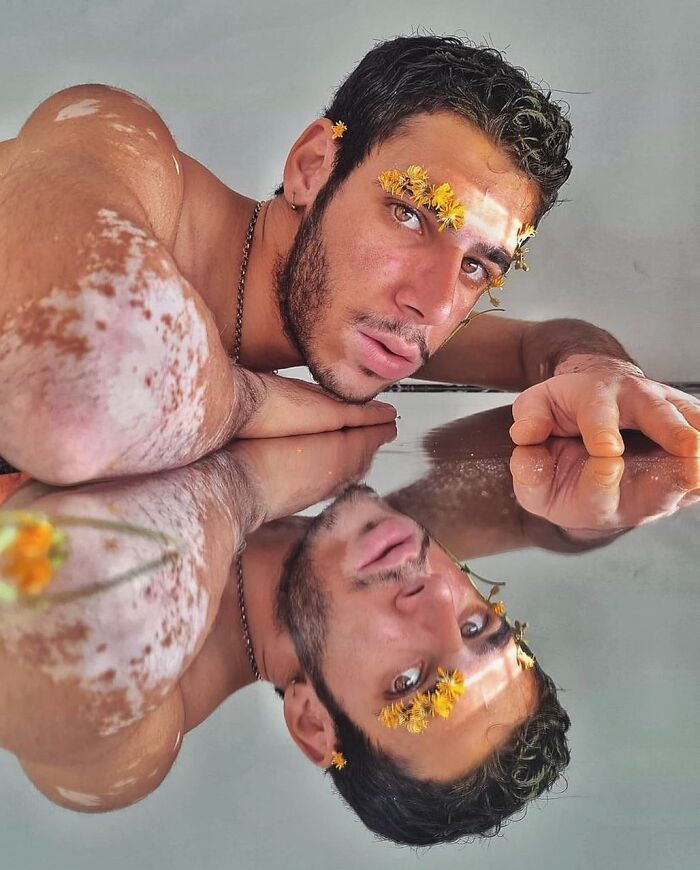 Wait, They Actually Made Vitiligo Look This Cool? 35 Pics That’ll Blow Your Mind