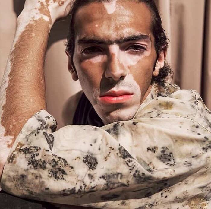 Wait, They Actually Made Vitiligo Look This Cool? 35 Pics That’ll Blow Your Mind