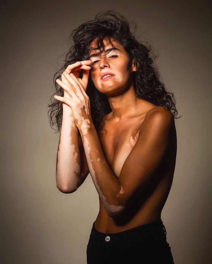 Wait, They Actually Made Vitiligo Look This Cool? 35 Pics That’ll Blow Your Mind